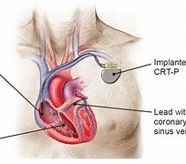 Image result for ICD Vs. CRT