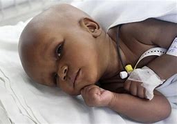 Image result for Babies Born with Hydrocephalus