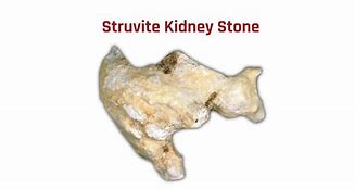 Image result for Struvite Kidney Stones