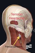 Image result for Tension Headache Neck Pain