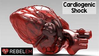 Image result for Cardiogenic Shock Illustration