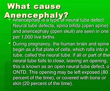 Image result for Anencephaly