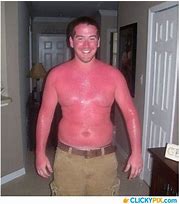 Image result for Bad Sunburn