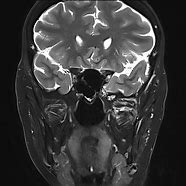 Image result for Encephalocele MRI