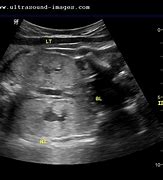 Image result for Fetal Kidneys Ultrasound