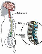 Image result for Meningomyelocele Gross Pathology