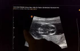 Image result for Cystic Hygroma Ultrasound Images