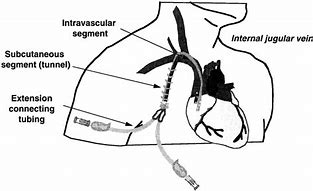 Image result for Jugular Venous Bulb Drainage Catheter