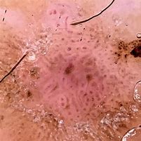 Image result for Dermoscopy Verruca