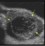 Image result for Ovarian Cyst Rupture Ultrasound