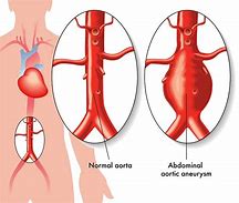 Image result for Abdominal Aortic Aneurysm Types