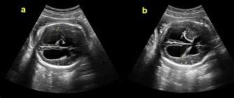 Image result for Fetal Head Ultrasound