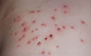 Image result for Molluscum Contagiosum Back Acne