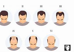 Image result for Balding in Teens