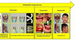 Image result for Corrective Jaw Surgery