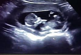 Image result for Hiding Twin Ultrasound
