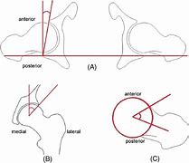 Image result for Hip Flexion Angle