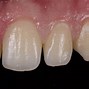 Image result for White Tooth Filling