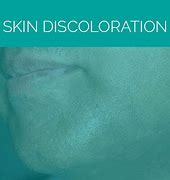 Image result for Skin Discoloration On Neck