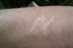 Image result for Burn Scars On Arm