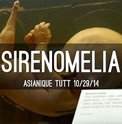 Image result for Sirenomelia