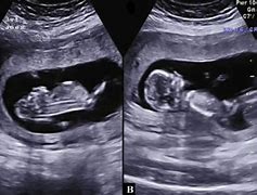 Image result for Anencephaly On 12 Week Ultrasound