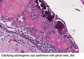 Image result for Calcifying Odontogenic Cyst