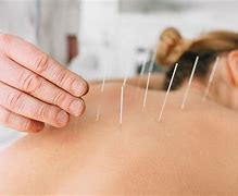 Image result for Acupuncture Pain Relief