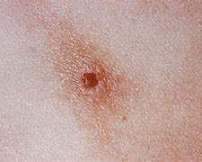 Image result for Gonorrhea Sores