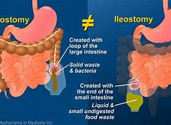 Image result for Ileostomy Stoma Colostomy Bag