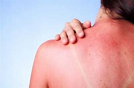 Image result for 2nd Degree SunBurn