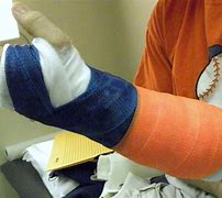 Image result for Broken Arm Cast