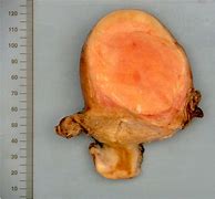Image result for Stroma Ovary