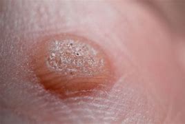 Image result for Wart Under Skin