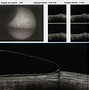 Image result for Scleral Lens Cross Section
