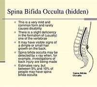 Image result for Spina Bifida Occulta S1 in Adults