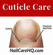 Image result for Wart On Cuticle