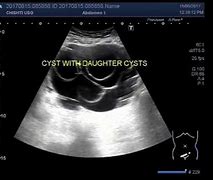 Image result for Ovarian Daughter Cyst Ultrasound