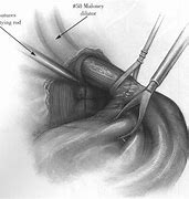 Image result for G Tube with Nissen Fundoplication