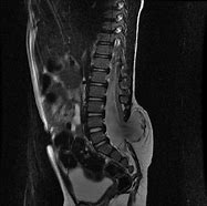 Image result for Myelomeningocele MRI