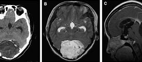 Image result for Occipital Cyst