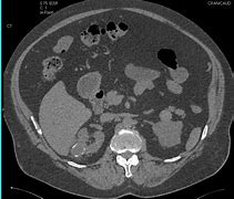 Image result for Complex Kidney Cyst MRI