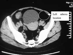 Image result for Left Adnexa CT Scan