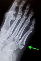 Image result for Fractured Metatarsal