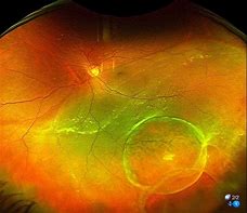 Image result for Retina Cyst