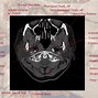 Image result for Bony Landmarks Head and Neck CT