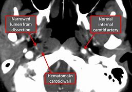 Image result for Carotid and Vertebral Arteries