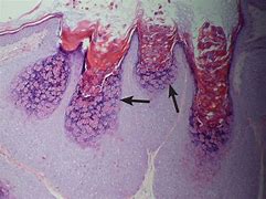 Image result for Molluscum Contagiosum and Aids