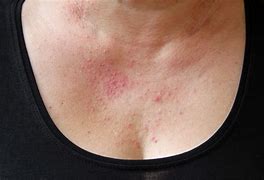 Image result for Nickel Eczema