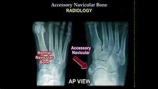Image result for Accessory Navicular Bone Foot